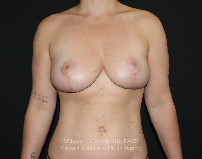 Breast Lift Before & After Gallery - Patient 399104 - Image 2