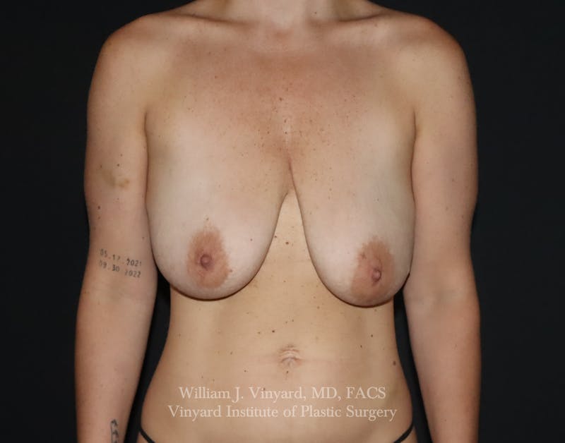 Breast Lift Before & After Gallery - Patient 399104 - Image 1