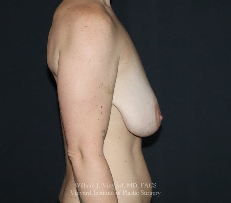 Breast Lift Before & After Gallery - Patient 399104 - Image 5