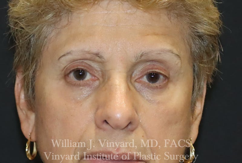Eyelid Before & After Gallery - Patient 463422 - Image 2