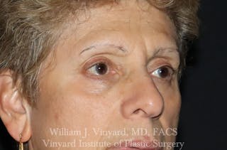 Eyelid Before & After Gallery - Patient 463422 - Image 4