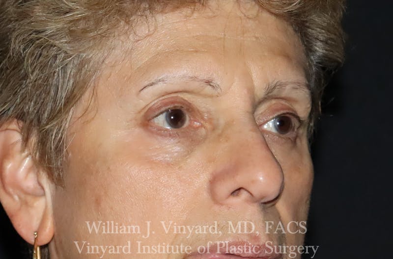 Eyelid Before & After Gallery - Patient 463422 - Image 4