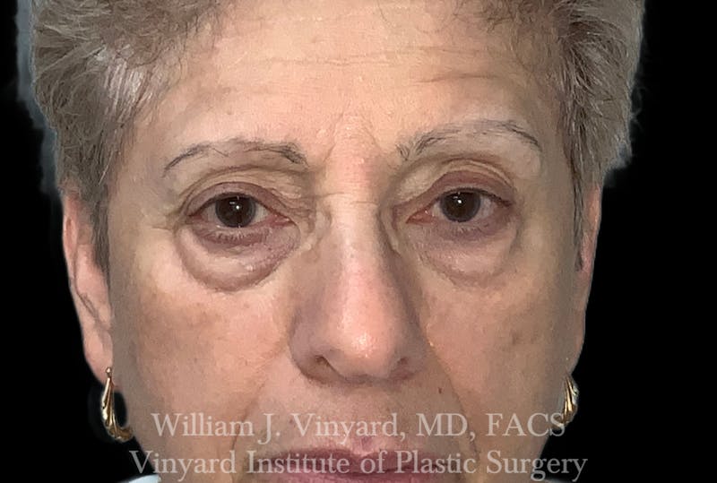 Eyelid Before & After Gallery - Patient 463422 - Image 1