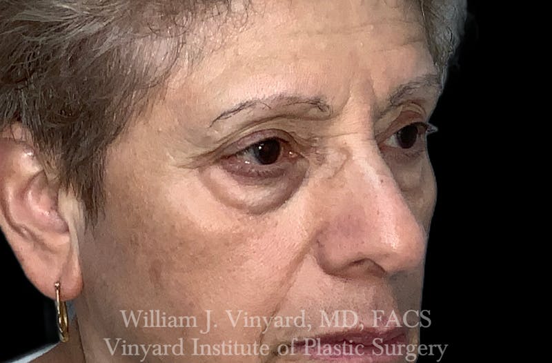 Eyelid Before & After Gallery - Patient 463422 - Image 3