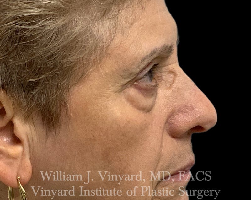 Eyelid Before & After Gallery - Patient 463422 - Image 5