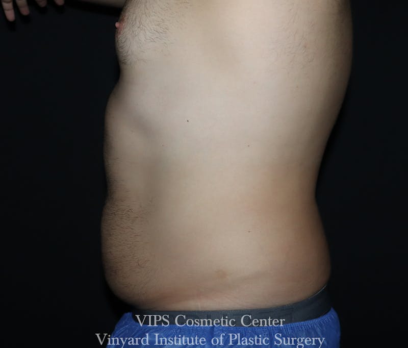 Coolsculpting ELITE Before & After Gallery - Patient 328984 - Image 2