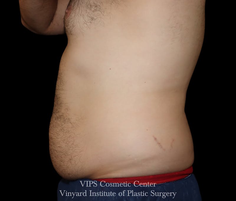 Coolsculpting ELITE Before & After Gallery - Patient 328984 - Image 1