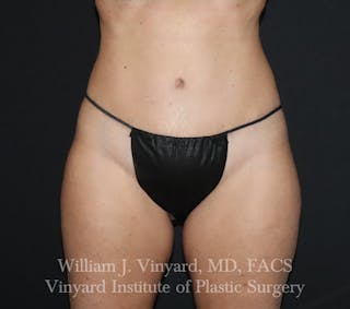 Tummy Tuck Before & After Gallery - Patient 314231 - Image 2