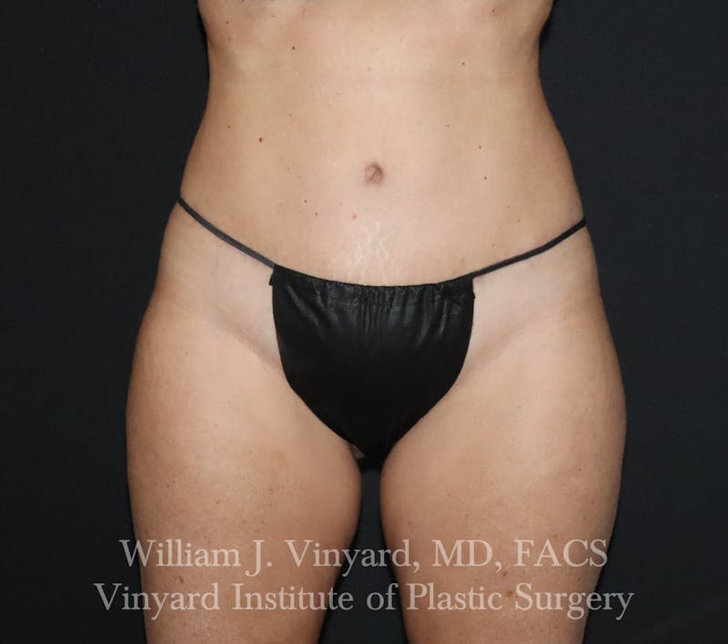 Tummy Tuck Before & After Gallery - Patient 314231 - Image 2