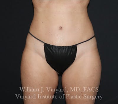 Tummy Tuck Before & After Gallery - Patient 314231 - Image 2