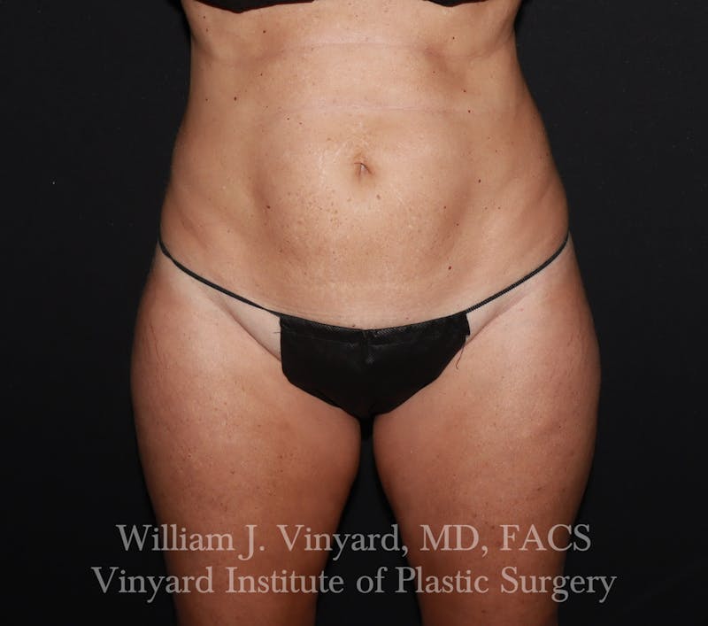 Tummy Tuck Before & After Gallery - Patient 314231 - Image 1