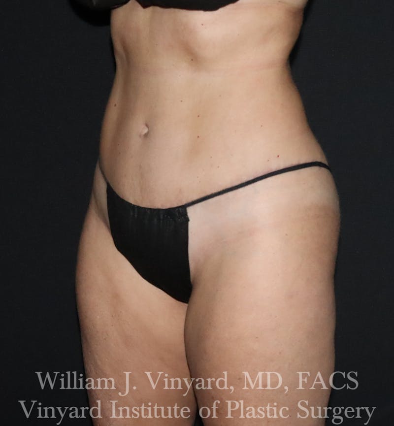 Tummy Tuck Before & After Gallery - Patient 314231 - Image 4