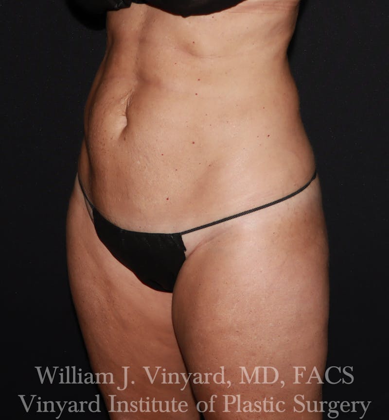 Tummy Tuck Before & After Gallery - Patient 314231 - Image 3