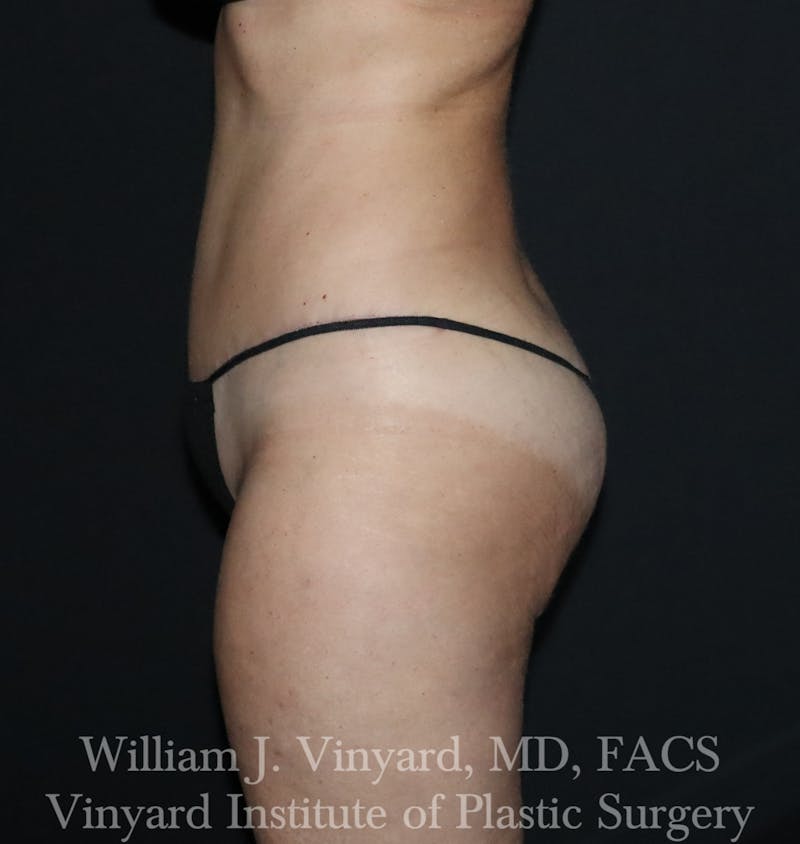 Tummy Tuck Before & After Gallery - Patient 314231 - Image 6