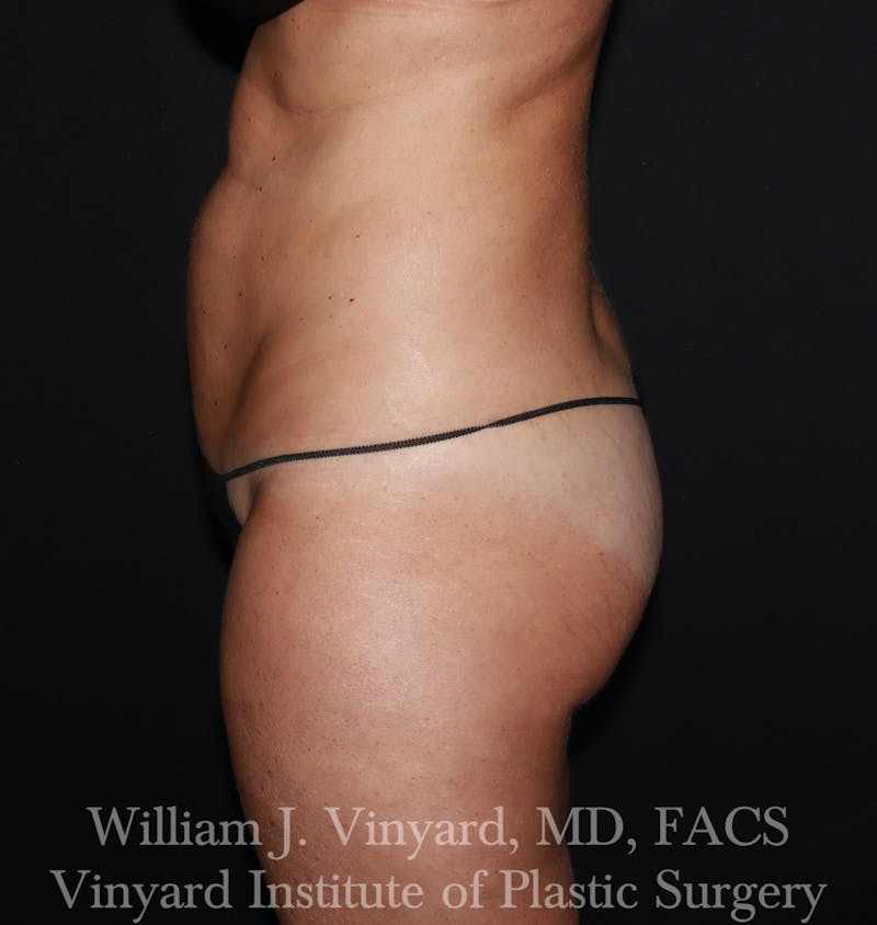 Tummy Tuck Before & After Gallery - Patient 314231 - Image 5