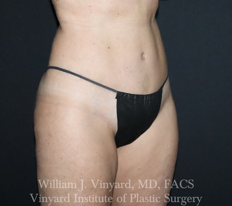 Tummy Tuck Before & After Gallery - Patient 314231 - Image 8