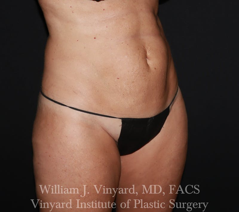 Tummy Tuck Before & After Gallery - Patient 314231 - Image 7