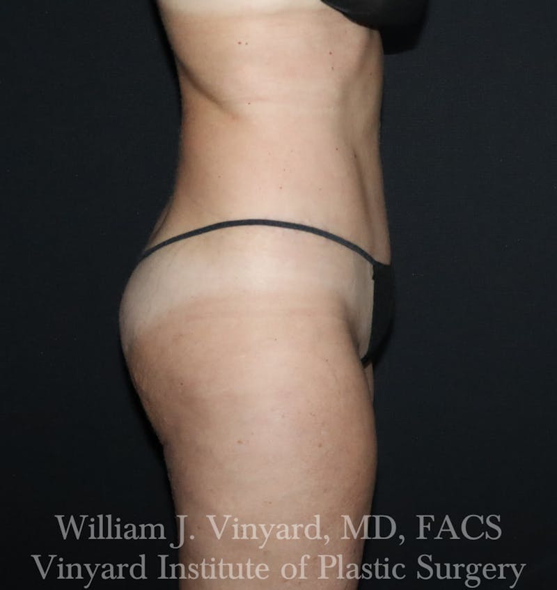 Tummy Tuck Before & After Gallery - Patient 314231 - Image 10