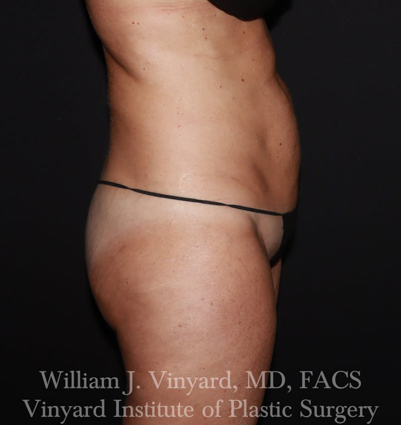 Tummy Tuck Before & After Gallery - Patient 314231 - Image 9