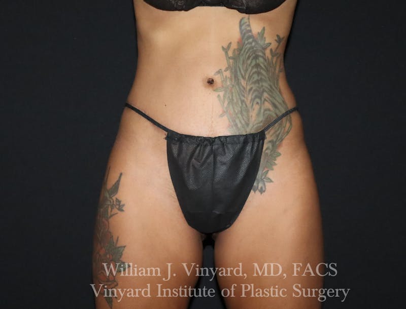 Tummy Tuck Before & After Gallery - Patient 953684 - Image 2