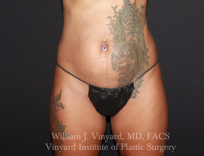Tummy Tuck Before & After Gallery - Patient 953684 - Image 1