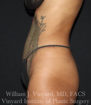 Tummy Tuck Before & After Gallery - Patient 953684 - Image 4