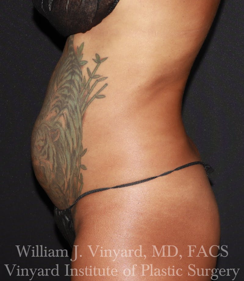 Tummy Tuck Before & After Gallery - Patient 953684 - Image 3