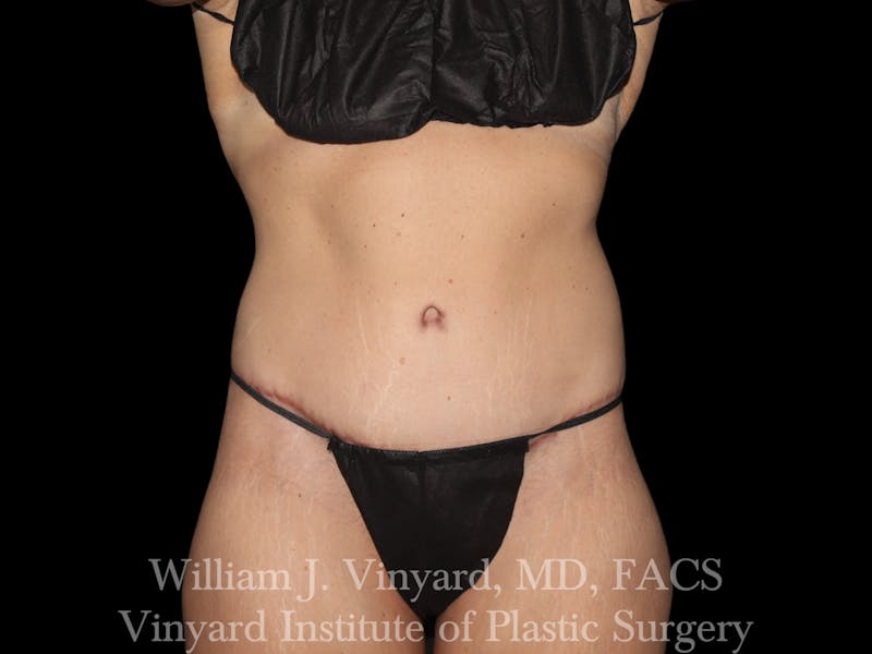 Tummy Tuck Before & After Gallery - Patient 251390 - Image 2