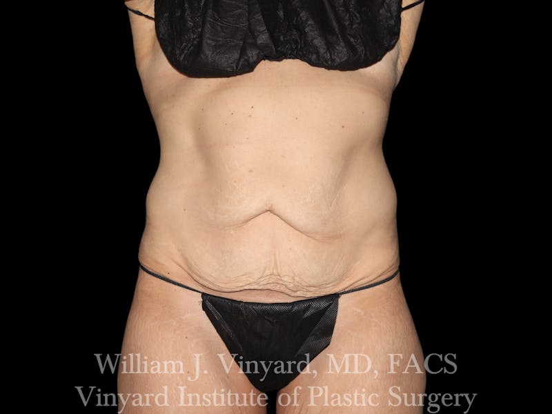 Tummy Tuck Before & After Gallery - Patient 251390 - Image 1