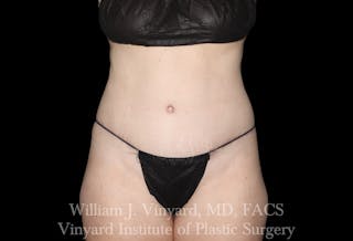 Tummy Tuck Before & After Gallery - Patient 191831 - Image 2