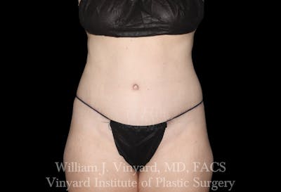 Tummy Tuck Before & After Gallery - Patient 191831 - Image 2