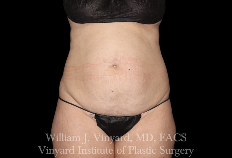 Tummy Tuck Before & After Gallery - Patient 191831 - Image 1