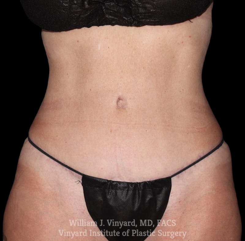 Tummy Tuck Before & After Gallery - Patient 326695 - Image 2