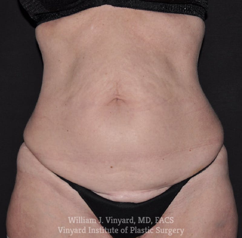 Tummy Tuck Before & After Gallery - Patient 326695 - Image 1