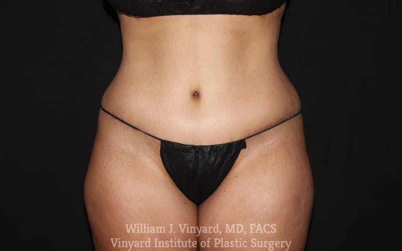 Tummy Tuck Before & After Gallery - Patient 199710 - Image 2