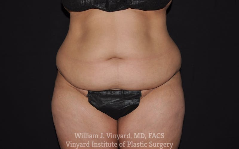 Tummy Tuck Before & After Gallery - Patient 199710 - Image 1