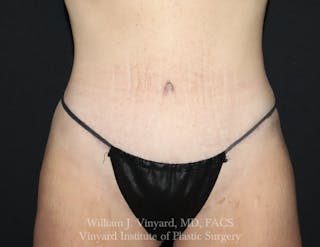 Tummy Tuck Before & After Gallery - Patient 490777 - Image 2