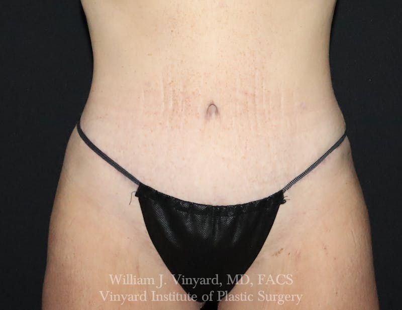 Tummy Tuck Before & After Gallery - Patient 490777 - Image 2