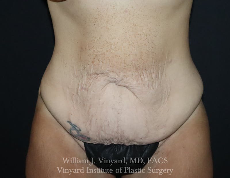 Tummy Tuck Before & After Gallery - Patient 490777 - Image 1