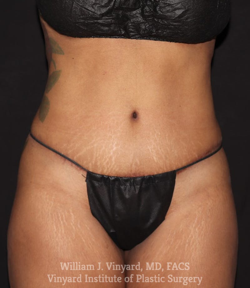 Tummy Tuck Before & After Gallery - Patient 142594 - Image 2