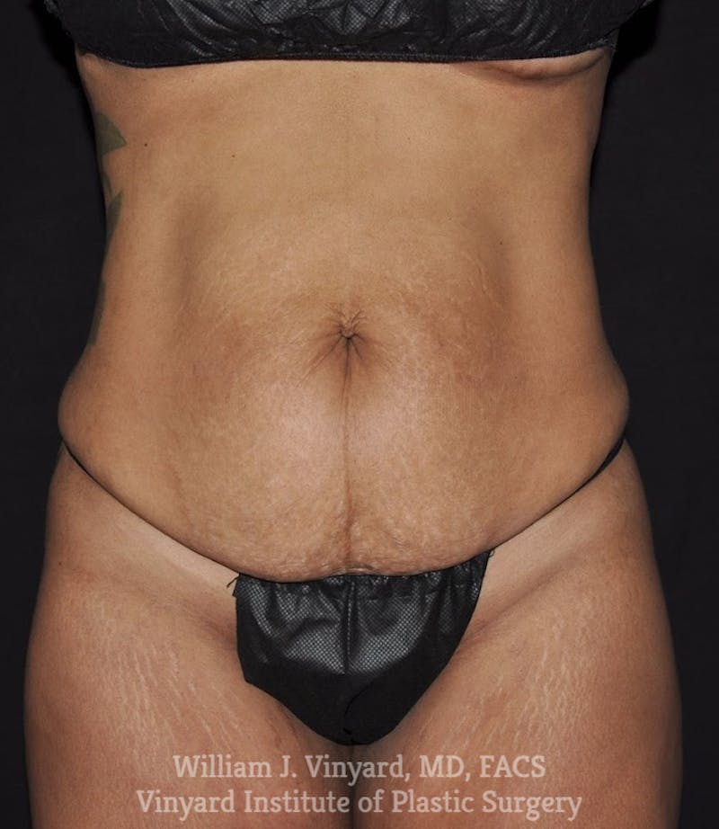 Tummy Tuck Before & After Gallery - Patient 142594 - Image 1