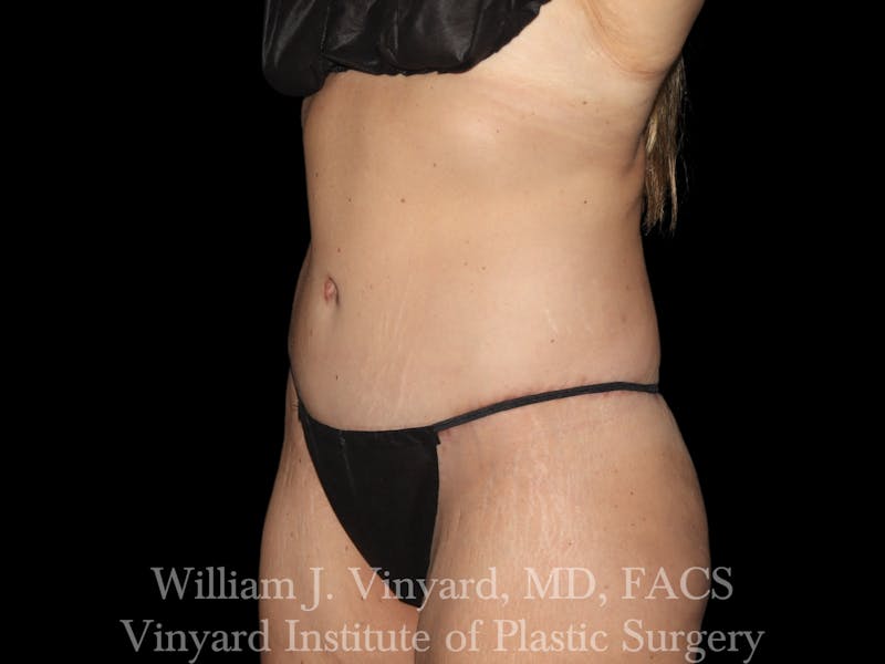 Tummy Tuck Before & After Gallery - Patient 251390 - Image 4