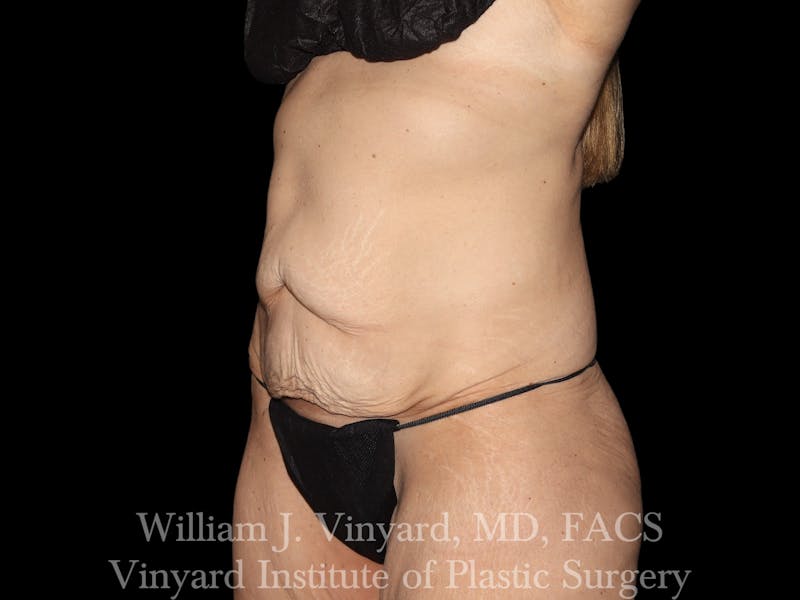 Tummy Tuck Before & After Gallery - Patient 251390 - Image 3