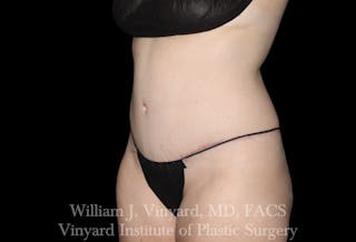 Tummy Tuck Before & After Gallery - Patient 191831 - Image 4