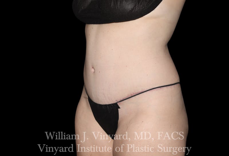 Tummy Tuck Before & After Gallery - Patient 191831 - Image 4
