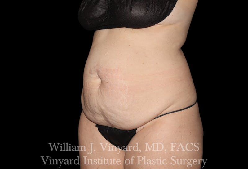 Tummy Tuck Before & After Gallery - Patient 191831 - Image 3