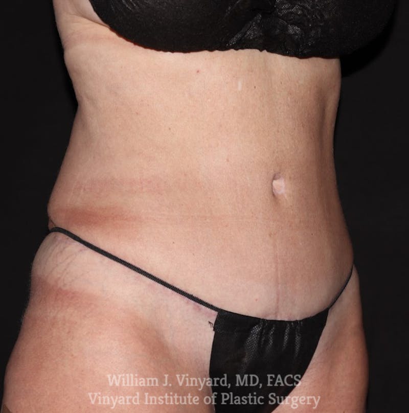 Tummy Tuck Before & After Gallery - Patient 326695 - Image 4