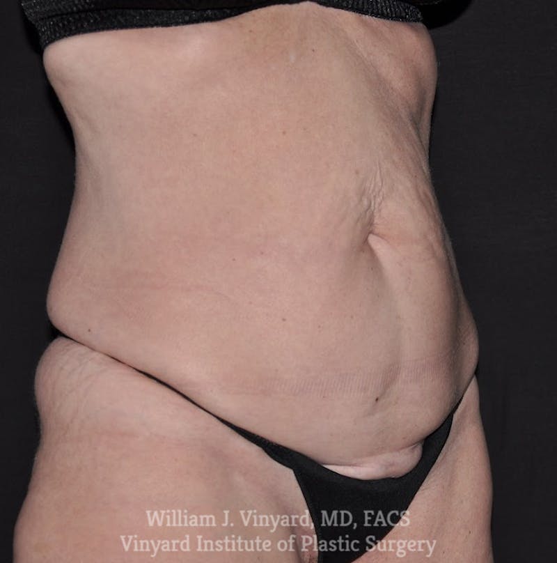 Tummy Tuck Before & After Gallery - Patient 326695 - Image 3