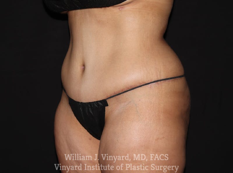 Tummy Tuck Before & After Gallery - Patient 199710 - Image 4