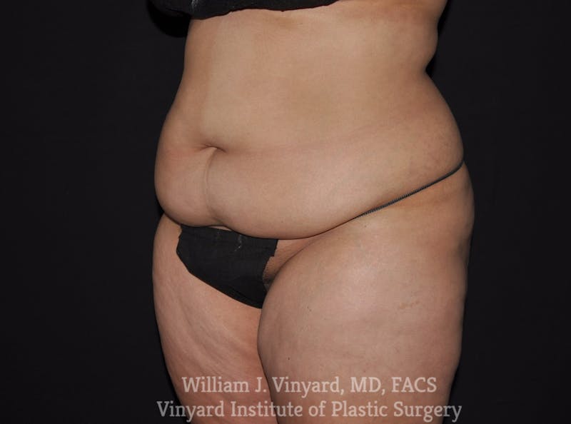 Tummy Tuck Before & After Gallery - Patient 199710 - Image 3